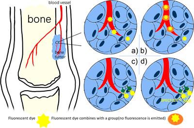 Progresses in Fluorescence Imaging Guidance for Bone and Soft Tissue Sarcoma Surgery